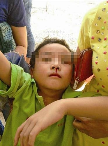 昨天上午，乐清市北白象镇第九小学，一名学生突然流鼻血被送往医院。 家长供图